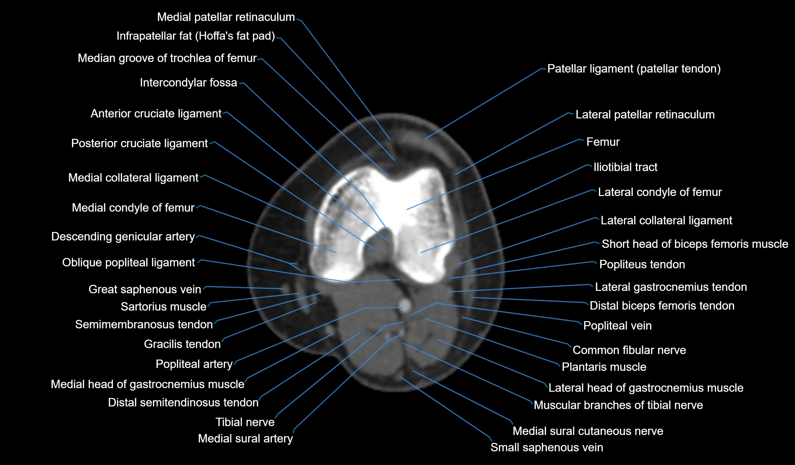 CT knee axial cross sectional anatomy labelled image-00032.webp